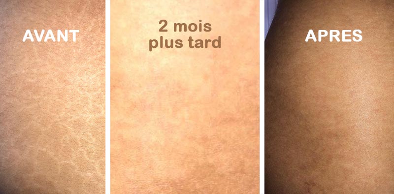 Créme - Anti-Cicatrice, vergeture, chéloïde
