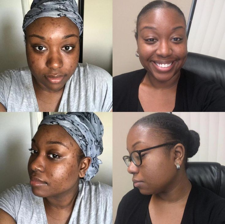 Crème Visage Kojic: Soin Complet Anti-Taches, Acné et Signes de l’Âge