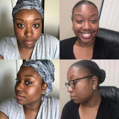 Crème Visage Kojic: Soin Complet Anti-Taches, Acné et Signes de l’Âge